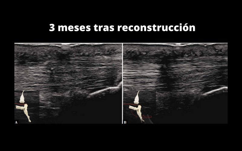 Tendon Aquiles tres meses despues cirugia ecografia.png